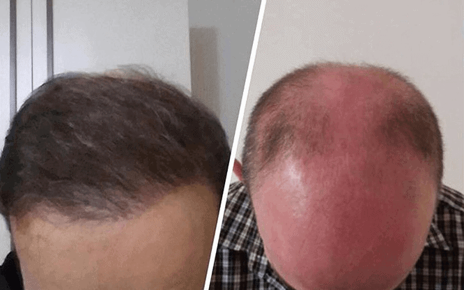 השתלת שיער בטורקיה לפני ואחרי