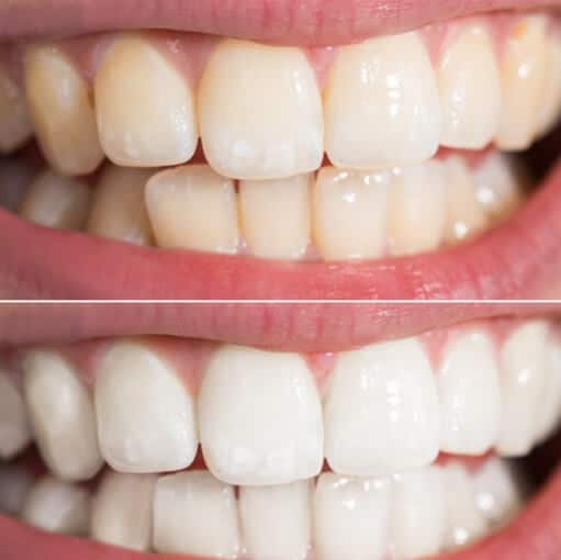 שיטות להלבנת שיניים